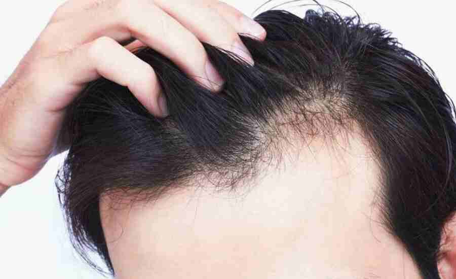 How to prevent Hair Loss | Hair loss treatment | How to grow Hair Naturally  - MANTHANHUB